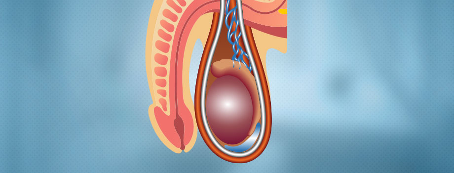 Hidrocele Imagem Hidrocele